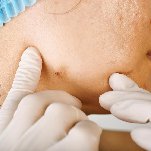 best pimple treatment in bangalore